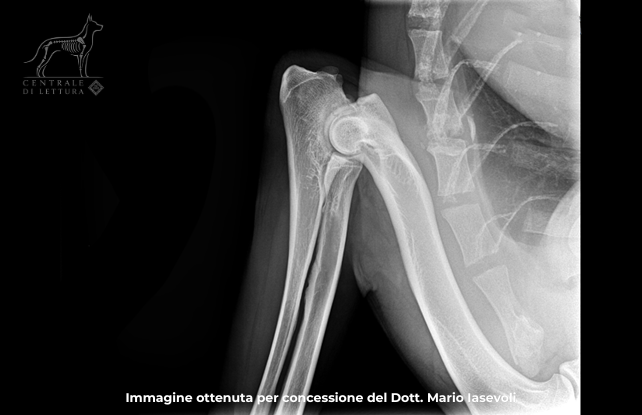 Gomito in posizione MLF. Grado 2. Presenza di osteofiti sul margine del processo anconeo di dimensioni 1.8 mm