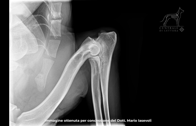 Gomito in posizione MLF. Grado 3. Presenza di osteofiti sul margine del processo anconeo di dimesioni 3,8 mm.